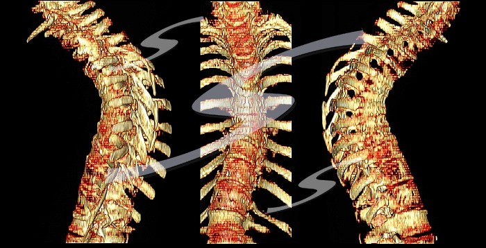 CT scan of thoracic spine with osteoporosis