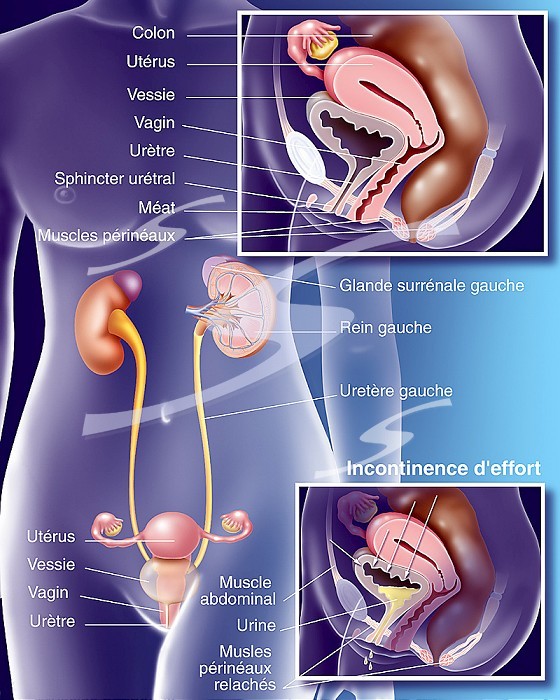 Urinary incontinence. Representation of the urinary system seen from the front in a woman´s body with two zooms showing: - at the top the anatomy of a non-incontinent woman with a well-toned pelvic floor. - below, the pelvic floor is distended and allows urinary leakage: incontinence during effort (sports activity, cough, etc.)