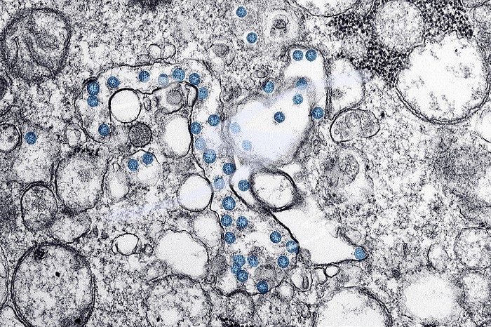 Transmission electron microscopic image of an isolate from the first U.S. case of COVID-19, formerly known as 2019-nCoV. The spherical viral particles, colorized blue, contain cross-sections through the viral genome, seen as black dots.