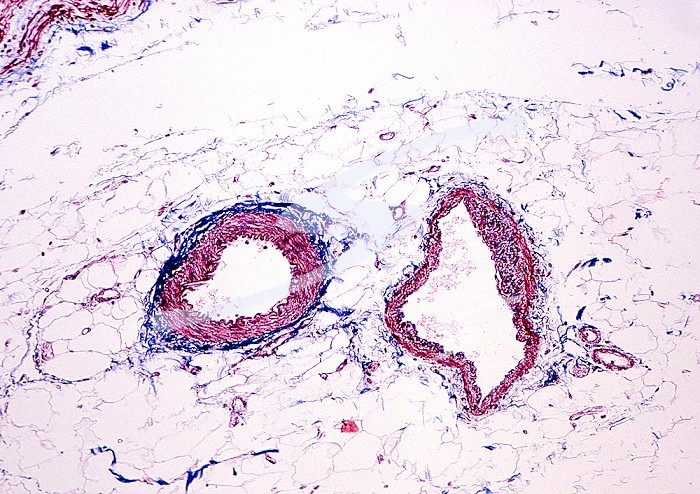 Human artery and vein in pericolic adipose tissue, trichrome stain. LM X26.